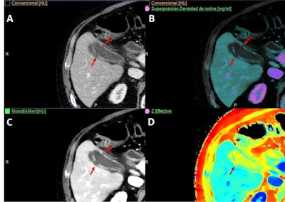 A 61-year-old man with colorectal cancer had a routine CT follow-up exam. (A) Conventional image shows incidental finding of gallbladder wall thickening with heterogeneous enhancement of its wall and mild inflammatory changes suspicious of cholecystitis. Spectral maps: iodine overlay map (B), low keV virtual monoenergetic (C), and Z-effective (D). All spectral images improve the assessment of wall enhancement and complications, such as perforation (arrows).