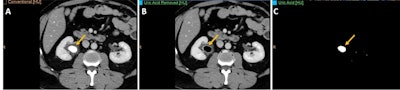 A 43-year-old man with right renal colic. (A) Conventional image shows a large stone in the right renal pelvis of indeterminate composition. (B, C) Spectral images confirm the presence of a uric acid stone. This is clinically relevant as uric acid calculi can be treated medically (urinary alkalinization), whereas other calculi (calcium, etc.) may require interventional procedures (stone removal or external shock wave lithotripsy). All figures courtesy of Dr. Ana Villanueva Campos et al and presented at RSNA 2023.