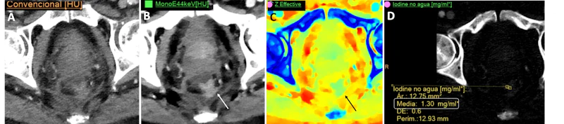 Spectral Ct Normal Spectral CT can boost outcome in tricky abdominal cases | AuntMinnieEurope