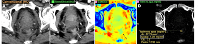 An 85-year-old man with previous rectal tumor and abdominoperineal excision of the rectum had a follow-up CT exam. (A) Conventional image shows an indeterminate soft tissue lesion at the anastomotic site that is barely visible. Virtual low keV monoenergetic image (B) and Z-effective (C) improve detection of this enhancing mass compared to conventional image. (D) Spectral map such as iodine no water also makes it possible to quantify the iodine uptake, which was 1.3 mg per mL in this case. All these findings were in keeping with local tumoral recurrence in the anastomotic site.