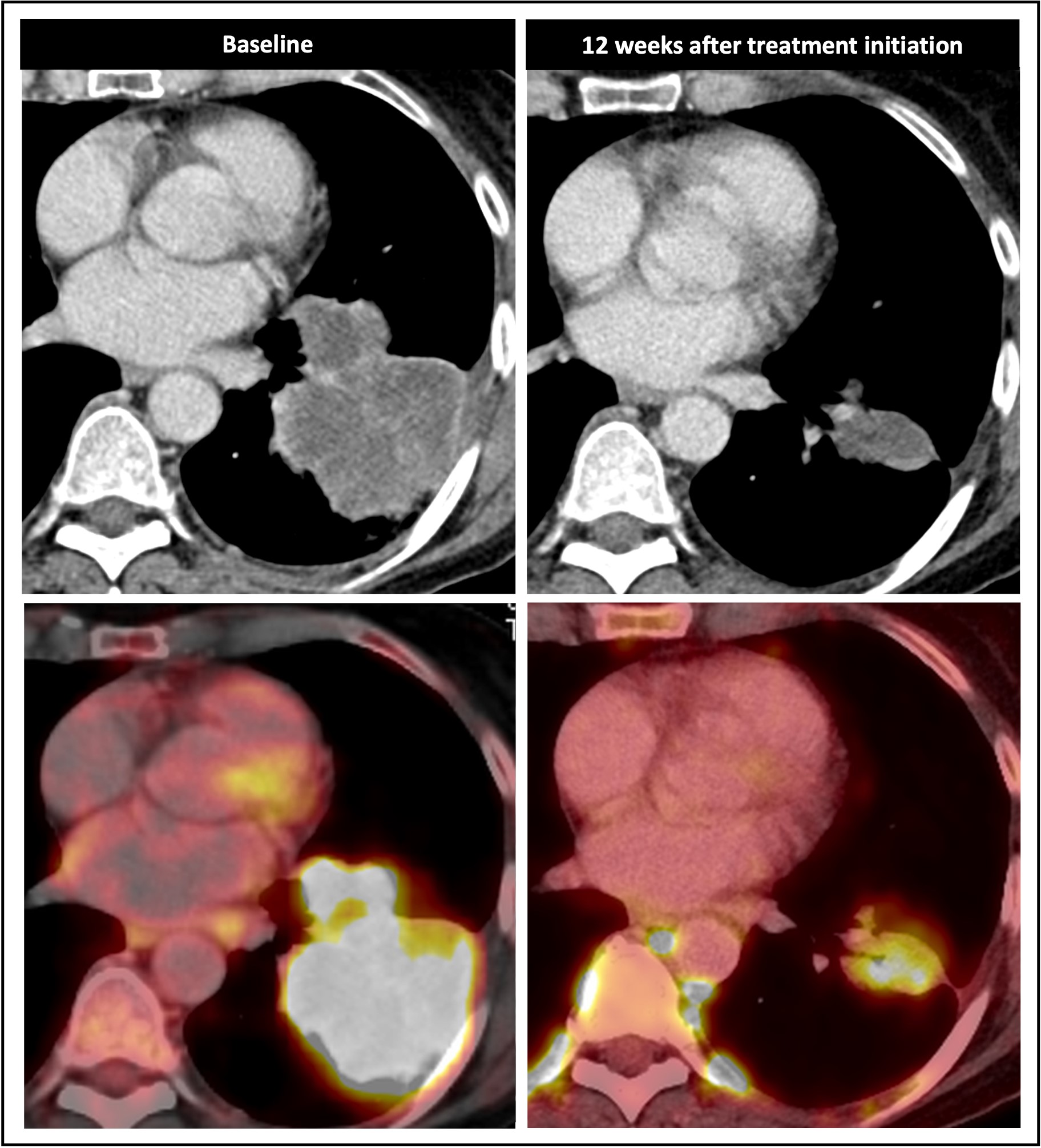 Radiological response inconsistent with pathological response: 69-year-old patient with non-small cell lung cancer (NSCLC) received a neoadjuvant treatment with three cycles of immune-checkpoint inhibitor therapy plus chemotherapy (ICIT + C, carboplatin/pemetrexed/pembrolizumab). 12 weeks after treatment began, the patient showed complete pathologic response (ypTo, pNo) but only partial radiological response.