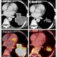 Radiological response inconsistent with pathological response: 69-year-old patient with non-small cell lung cancer (NSCLC) received a neoadjuvant treatment with three cycles of immune-checkpoint inhibitor therapy plus chemotherapy (ICIT + C, carboplatin/pemetrexed/pembrolizumab). 12 weeks after treatment began, the patient showed complete pathologic response (ypTo, pNo) but only partial radiological response.
