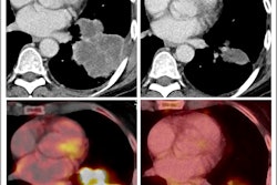 Radiological response inconsistent with pathological response: 69-year-old patient with non-small cell lung cancer (NSCLC) received a neoadjuvant treatment with three cycles of immune-checkpoint inhibitor therapy plus chemotherapy (ICIT + C, carboplatin/pemetrexed/pembrolizumab). 12 weeks after treatment began, the patient showed complete pathologic response (ypTo, pNo) but only partial radiological response.