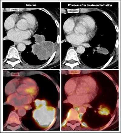 Radiological response inconsistent with pathological response: 69-year-old patient with non-small cell lung cancer (NSCLC) received a neoadjuvant treatment with three cycles of immune-checkpoint inhibitor therapy plus chemotherapy (ICIT + C, carboplatin/pemetrexed/pembrolizumab). 12 weeks after treatment began, the patient showed complete pathologic response (ypTo, pNo) but only partial radiological response.