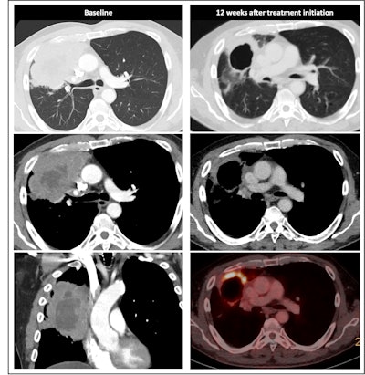 Radiological response inconsistent with pathological response: 75-year-old patient received a neoadjuvant treatment with three cycles of ICIT + C (carboplatin/pemetrexed/pembrolizumab). 12 weeks after treatment began, the patient showed complete pathologic response (ypTo, pNo) but only partial radiological response.