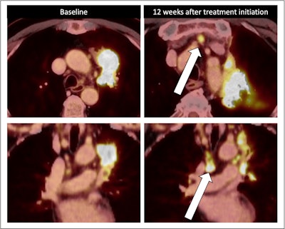 Nodal immune flare: 72-year-old patient with NSCLC received a neoadjuvant treatment with three cycles of ICIT + C (carboplatin/pemetrexed/pembrolizumab). 12 weeks after treatment began, the patient showed an increase in size and FDG avidity but also major pathologic response with less than 10% of vital tumor burden (ypT1a, No, Ro [local]). All figures courtesy of Dr. Daria Kifjak and Dr. Lucian Beer.
