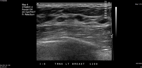 Breast Ultrasound