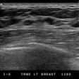 Breast Ultrasound