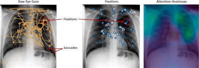 Difference between saccades, fixations, and attention heatmaps in radiologist eye-tracking studies. Image courtesy of the European Journal of Radiology.