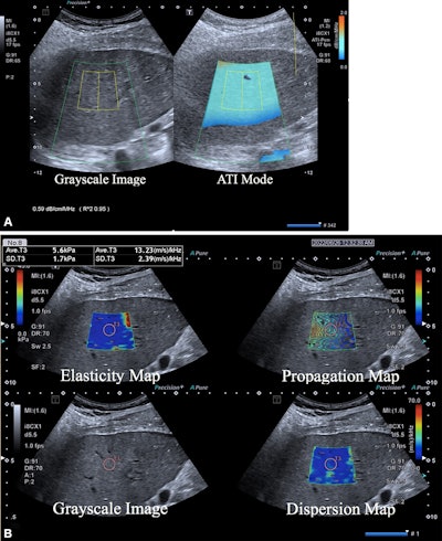 Multiparametric ultrasound in a 52-year-old female patient with metabolic dysfunction-associated fatty liver disease (MAFLD) and hepatitis B, whose body mass index was 26.9. (A) Gray-scale image (left) shows the liver parenchyma, and attenuation image (right) shows the right liver lobe acquired from the right intercostal oblique plane, with the degree of attenuation color-coded in the sampling box. Orange indicates a high attenuation coefficient and blue indicates a low attenuation coefficient. The coefficient value (0.59 dB/cm/MHz) and reliability index (R2 = 0.95) are presented in the lower left corner. (B) 2D shear-wave elastography-generated quad-view mode image shows an elasticity map, propagation map, gray-scale image, and dispersion map at the same time. A 1-cm region of interest is placed within the sampling box of each image. Red and blue indicate high and low elasticity and dispersion slope, respectively. Liver stiffness on the elasticity map is 5.6 kPa, and the dispersion slope on the dispersion map is 13.23 (m/sec)/kHz. Image courtesy of the RSNA.
