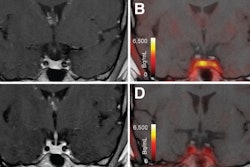 Cushing Disease