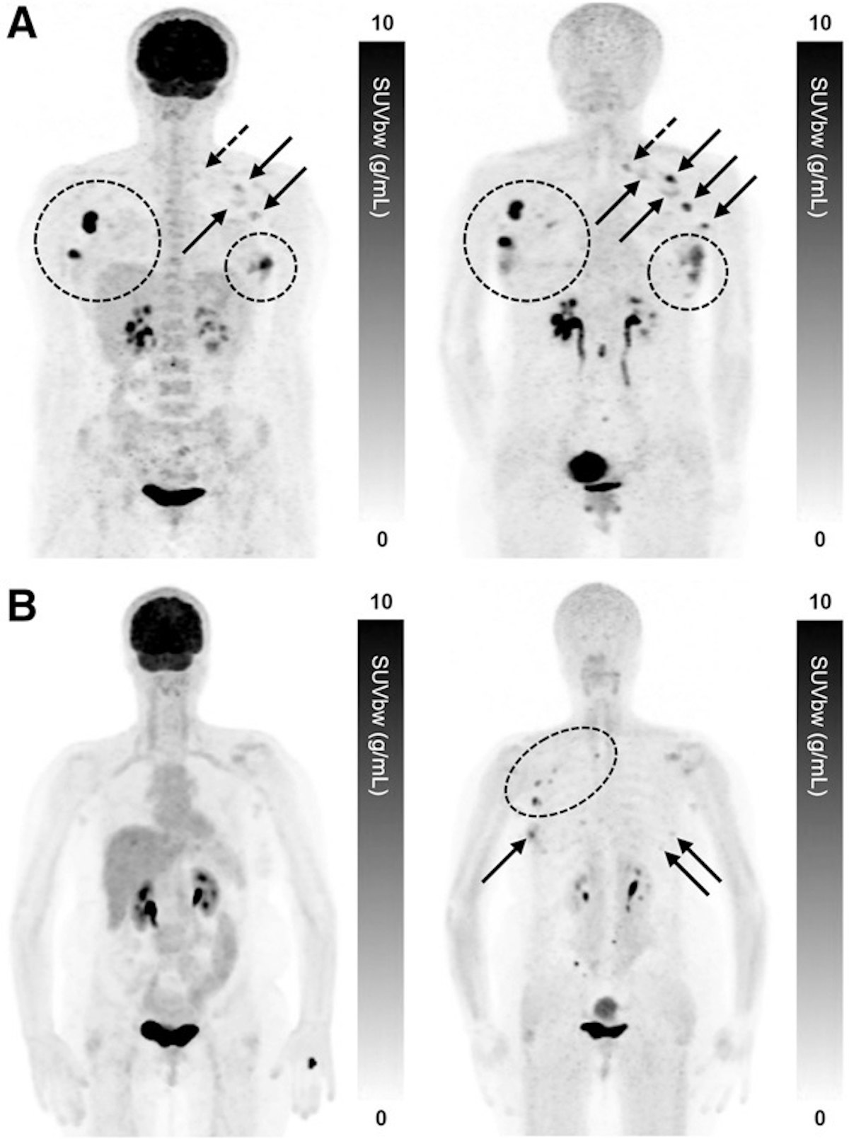 FAPI-PET/CT outperforms FDG-PET/CT in women with invasive breast cancer ...
