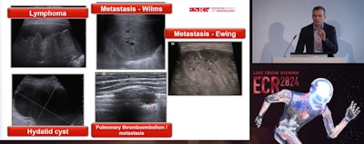 Jovan Lovrenski, MD, PhD, from the University of Novi Sad in Serbia explains the diverse use of lung ultrasound in pediatric imaging in an ECR 2024 presentation.