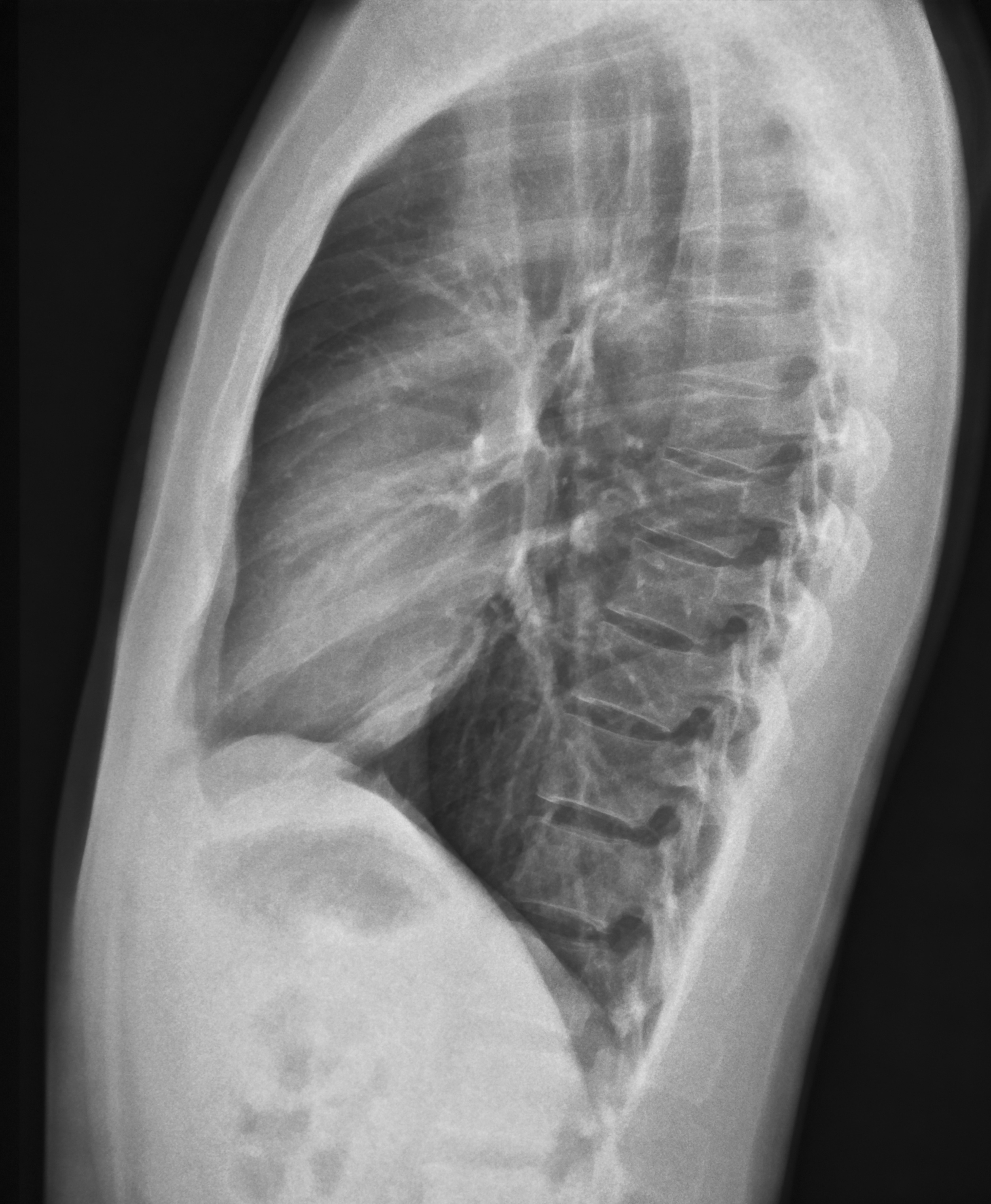 Chest X Ray Lateral View