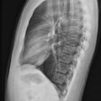 Chest X Ray Lateral View