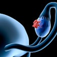 Ovarian Cancer