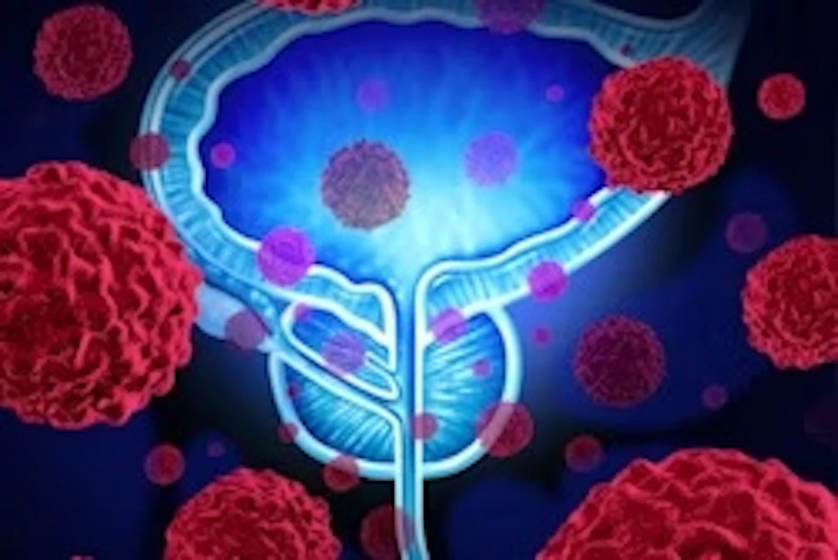 サマセット州の NHS が前立腺がん画像処理に AI を導入