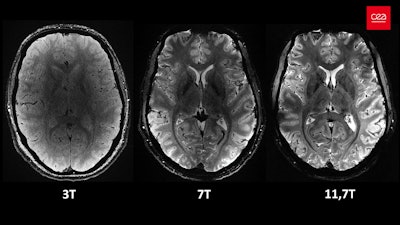 Axial view of the human brain at the same resolution (0.2 mm in-plane resolution and 1 mm slice thickness), with an identical acquisition time of around four minutes but at different magnetic field strengths. At 3 tesla and at 7 tesla (only three such machines in France and around 100 worldwide), the precision and sharpness are lower. At 3 tesla, a 'grainy' cloud prevents the anatomical structures of the brain from being clearly delineated. At 7 tesla, when zooming, the level of detail at this resolution is reduced. At 11.7 tesla, the scan provides more signals and greater contrasts between biological tissues, which allows more detailed exploration of the brain. All images courtesy of CEA.