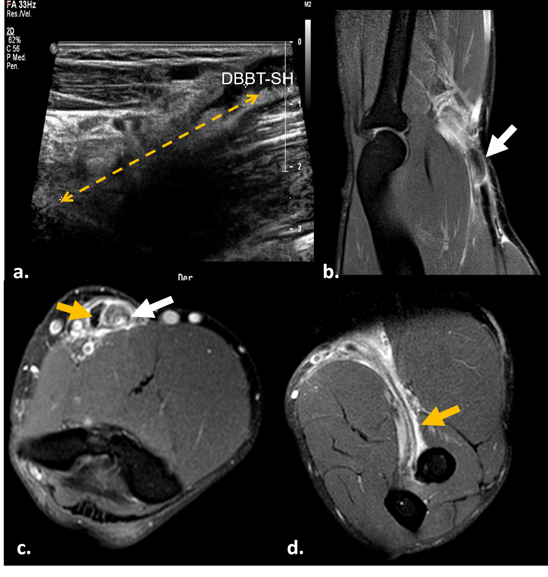 Ultrasound longitudinal view of distal biceps brachii tendon tear (a). A month later, MRI fat-suppressed proton-density sagittal (b), axial (c), and forearm supinated (FABS) position (d) sequences were performed. Complete full-thickness tear of the distal tendon of the short head of the biceps brachii is visible, with retracted and thickened torn end at the MTJ (white arrow). Some isolated fibers of the partially torn long-head tendon are visible in the radial tuberosity (orange arrow).