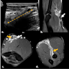 Ultrasound longitudinal view of distal biceps brachii tendon tear (a). A month later, MRI fat-suppressed proton-density sagittal (b), axial (c), and forearm supinated (FABS) position (d) sequences were performed. Complete full-thickness tear of the distal tendon of the short head of the biceps brachii is visible, with retracted and thickened torn end at the MTJ (white arrow). Some isolated fibers of the partially torn long-head tendon are visible in the radial tuberosity (orange arrow).