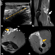 Ultrasound longitudinal view of distal biceps brachii tendon tear (a). A month later, MRI fat-suppressed proton-density sagittal (b), axial (c), and forearm supinated (FABS) position (d) sequences were performed. Complete full-thickness tear of the distal tendon of the short head of the biceps brachii is visible, with retracted and thickened torn end at the MTJ (white arrow). Some isolated fibers of the partially torn long-head tendon are visible in the radial tuberosity (orange arrow).