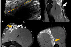 Ultrasound longitudinal view of distal biceps brachii tendon tear (a). A month later, MRI fat-suppressed proton-density sagittal (b), axial (c), and forearm supinated (FABS) position (d) sequences were performed. Complete full-thickness tear of the distal tendon of the short head of the biceps brachii is visible, with retracted and thickened torn end at the MTJ (white arrow). Some isolated fibers of the partially torn long-head tendon are visible in the radial tuberosity (orange arrow).