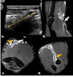 Ultrasound longitudinal view of distal biceps brachii tendon tear (a). A month later, MRI fat-suppressed proton-density sagittal (b), axial (c), and forearm supinated (FABS) position (d) sequences were performed. Complete full-thickness tear of the distal tendon of the short head of the biceps brachii is visible, with retracted and thickened torn end at the MTJ (white arrow). Some isolated fibers of the partially torn long-head tendon are visible in the radial tuberosity (orange arrow).