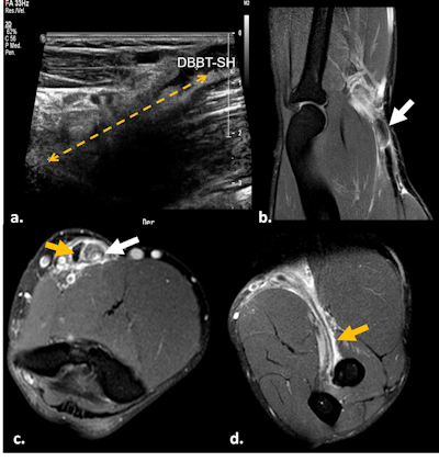 Ultrasound longitudinal view of distal biceps brachii tendon tear (a). A month later, MRI fat-suppressed proton-density sagittal (b), axial (c), and forearm supinated (FABS) position (d) sequences were performed. Complete full-thickness tear of the distal tendon of the short head of the biceps brachii is visible, with retracted and thickened torn end at the MTJ (white arrow). Some isolated fibers of the partially torn long-head tendon are visible in the radial tuberosity (orange arrow).