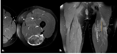 BAMIC 3b injury. Fat-suppressed proton-density weighted axial (a) and coronal images (b) show muscle edema >15 cm (white dotted line) at the myotendinous/intramuscular tendon, with tendon distortion >5 cm (orange dotted line) with a wavy appearance. Interfascial hematoma and surrounding the ischiatic nerve (black arrow). Semitendinous (ST), biceps femoris (BF).