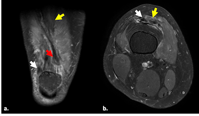 Quadriceps tendon rupture. Fat-suppressed proton density-weighted coronal (a) and axial (b) images show complete rupture of the conjoined portion of the vastus medialis and lateralis tendons of the quadriceps at its medial margin, with torn end retracted 2 cm (red arrow). Lateral insertion into the patella is preserved (white arrows). Complete rupture of the intermediate vastus (yellow arrow).