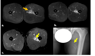 Fat-suppressed T2-weighted (a,b) and fat-suppressed proton density-weighted (c) axial images. Myotendinous injury at the mid/distal aspect of the insertion of the adductor longus, with hematoma (black asterisks) and surrounding edema (orange arrow), which corresponds to British Athletics Muscle Injury Classification (BAMIC) 2b injury. Follow-up MRI (c) and x-ray (d) depicted a pseudonodular lesion with a surrounding hypointense halo (c) within the previous affected area, related to the evolution of ossifying myositis. All images courtesy of Dr. Pablo Vargas Avila et al, Hospital Universitario 12 de Octubre, Madrid, and presented at ECR 2024.