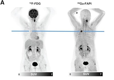 F-18 FDG and Ga-68 FAPI-46 images of a 51-year-old woman with adenocarcinoma with lepidic growth pattern in right upper lobe. (A) Maximum-intensity-projection PET images. The lesion had F-18 FDG uptake below blood pool level but was strongly Ga-68 FAPI-46-positive. CT-guided biopsy led to pathologic diagnosis of adenocarcinoma, and the patient was treated by stereotactic body radiation therapy because of functional inoperability. Image courtesy of the Journal of Nuclear Medicine.