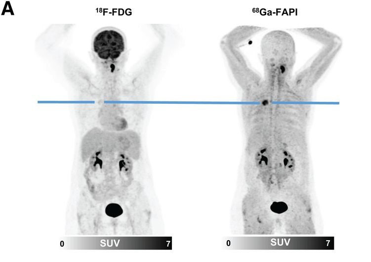 Fapi Lung Cancer