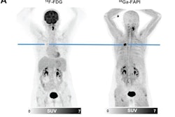 Fapi Lung Cancer