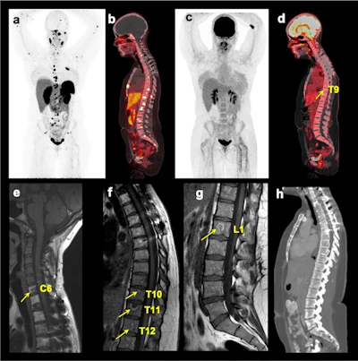 PET/CT superior to MRI for detecting spinal bone metastases ...