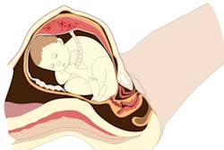 Fetus Breech 400