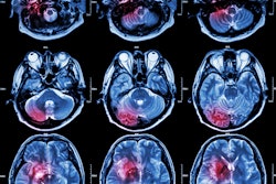 Stroke Mri