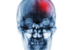 Stroke Skull Xray