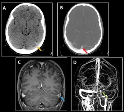 Cerebral venous thrombosis in a 25-year-old woman with a two-week history of left-sided oppressive hemicranial headache and neck pain. (A) Nonenhanced CT shows hyperattenuation of the left transverse and sigmoid sinuses (dense sinus sign) with cortical venous engorgement (yellow arrow). (B) Venous CT angiography shows a filling defect involving the left transverse sinus up to the confluence with the superior sagittal sinus (red arrow), the sigmoid sinus, and the intracranial internal jugular vein. (C-D) MRI sequences confirm a filling defect after gadolinium administration in the left transverse sinus (empty delta sign, blue arrow in C), and the absence of signal on the 3D time-of-flight venous sequence in the left sigmoid and transverse sinuses up to the torcula and in the middle and lower thirds of the superior sagittal sinus (green arrow in D). Factor V Leiden Mutation was disovered. (All images courtesy of Dr. Ana Berasategui Criado et al and presented at ECR 2024).