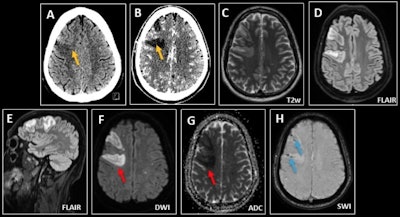 Septic emboli in a 40-year-old man with headache and acute confusional state in the context of bacterial endocarditis. (A-B) CT demonstrates a focal area of right frontal cortical edema, more evident in the postcontrast phase (yellow arrows), compatible with a subacute infarct or low-grade neoplasia. (C-G) MRI shows multiple scattered foci of increased intensity on T2/FLAIR, with restricted diffusion in both cerebral hemispheres, suggesting embolic infarcts (red arrows). (H) Dominant right frontal lesions associate microhemorrhage on susceptibility-weighted imaging (blue arrows).