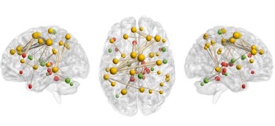 This modeled connectome image shows more cumulative clinical risk correlates strongly with reduced network strength in a fronto-parietal-thalamic network of patients with congenital heart disease. Figure courtesy of Melanie Ehrler, PhD, et al.