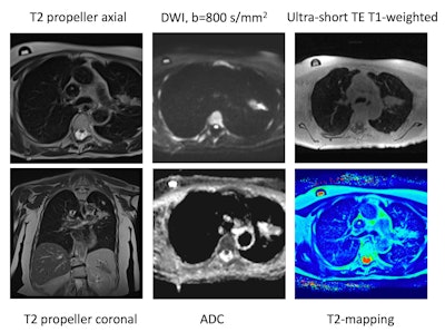 0.55T lung MRI protocol. Example protocol includes respiratory-navigated T2 BLADE breath-triggered (coronal and axial), 3D respiratory-navigated T1 ultrashort echo time (UTE), diffusion-weighted imaging (DWI) sequences, and T2-mapping, with the potential of adding susceptibility weighted imaging and other sequences in the future. All figures courtesy of Felicia Tang et al and presented at ISMRM 2024.