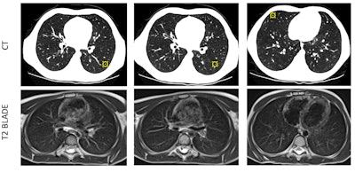 CT has an advantage in detection of small pulmonary nodules compared to 0.55T MRI. A 7-year-old boy's three small pulmonary nodules (3 mm, 2 mm, and 3 mm) in bilateral lungs were detected on CT but not on 0.55T MRI. CT is still superior for detection of small nodules -- a limitation of 0.55T MRI.