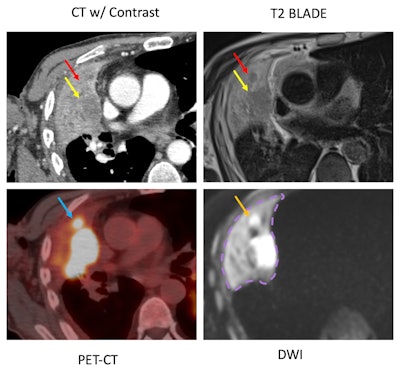Example case shows advantages of DWI sequence in detecting a mass hidden inside atelectasis. CT chest, PET-CT, T2 BLADE, and DWI are compared for a 72-year-old male patient with a satellite nodule (red arrow) obscured by atelectasis adjacent to the dominant right upper lobe mass (yellow arrow) in CT. However, DWI image demonstrates restricted diffusion (orange yellow) corresponding to focal FDG uptake (blue arrow) within the satellite nodule.