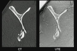 Sagittal view of the scapula showing a comminuted fracture of the inferior portion, imaged with computed tomography (CT, left image) and by an ultrashort time of echo (UTE) sequence (right image) on MRI. Both images appear similar, with an identical representation of the fracture, illustrating the potential of UTE to create CT-like images and suggesting that both imaging modalities could be interchangeable in clinical practice. All images and captions courtesy of Prof. Benjamin Fritz, MD.