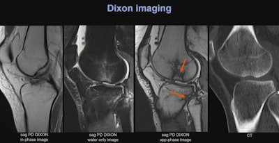 A 15-year-old female soccer player presented with a knee distortion featuring a pivot-shift injury mechanism and an osseous avulsion of the anterior cruciate ligament (left image). PD-weighted MRI images were acquired using the Dixon technique, capable of displaying bone marrow edema patterns at the lateral femoral condyle adjacent to a small cortical impression fracture, and at the proximal tibiofibular joint, indicative of a nondisplaced trabecular microfracture. In the opposed-phase images of the PD-weighted Dixon sequence, a typical linear hypointense artifact (India ink artifact) is visible along the borders of the trabecular microfractures, which can be beneficial in clinical practice for the detection of fractures. For comparison, a computed tomography image is provided on the right.