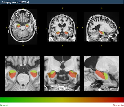 Example of HAVA score using the volBrain platform for a 70-year-old male with late mild cognitive impairment. All figures courtesy of Dr. Alexandru Fulga et al and presented at ECR 2024.