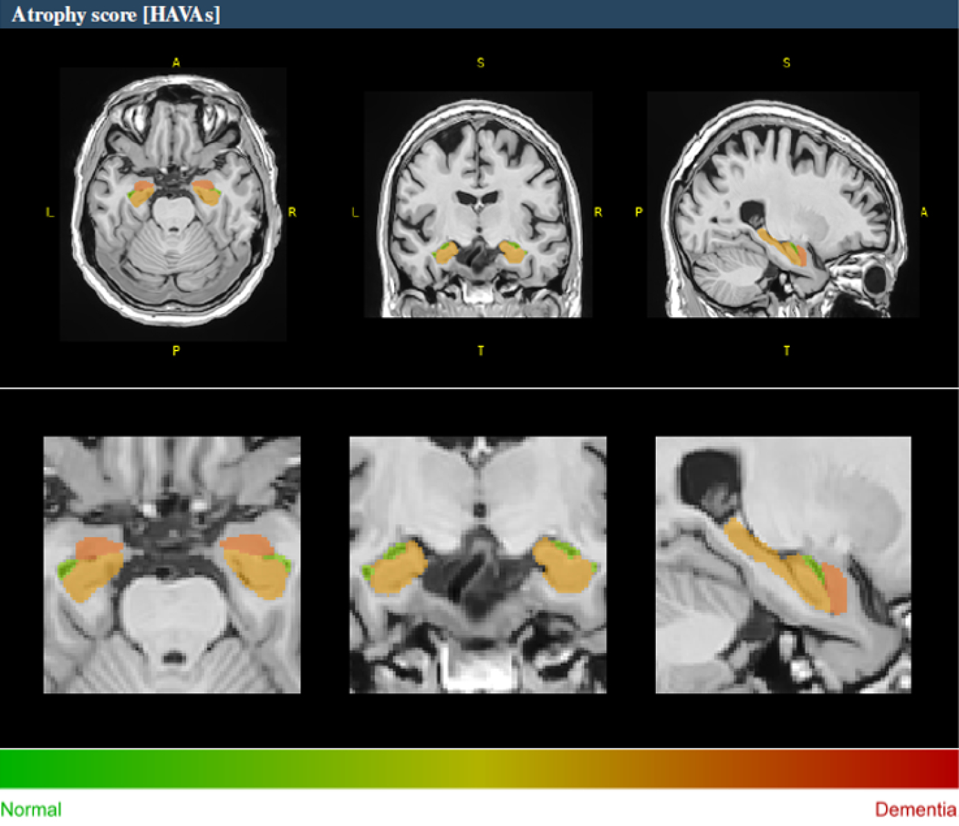 Example of HAVA score using the volBrain platform for a 70-year-old male with early mild cognitive impairment.