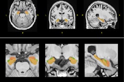 Example of HAVA score using the volBrain platform for a 70-year-old male with early mild cognitive impairment.