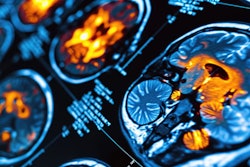 High Resolution Pet Ct Brain Scan